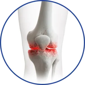Image of the bony junction with the appearance of pain